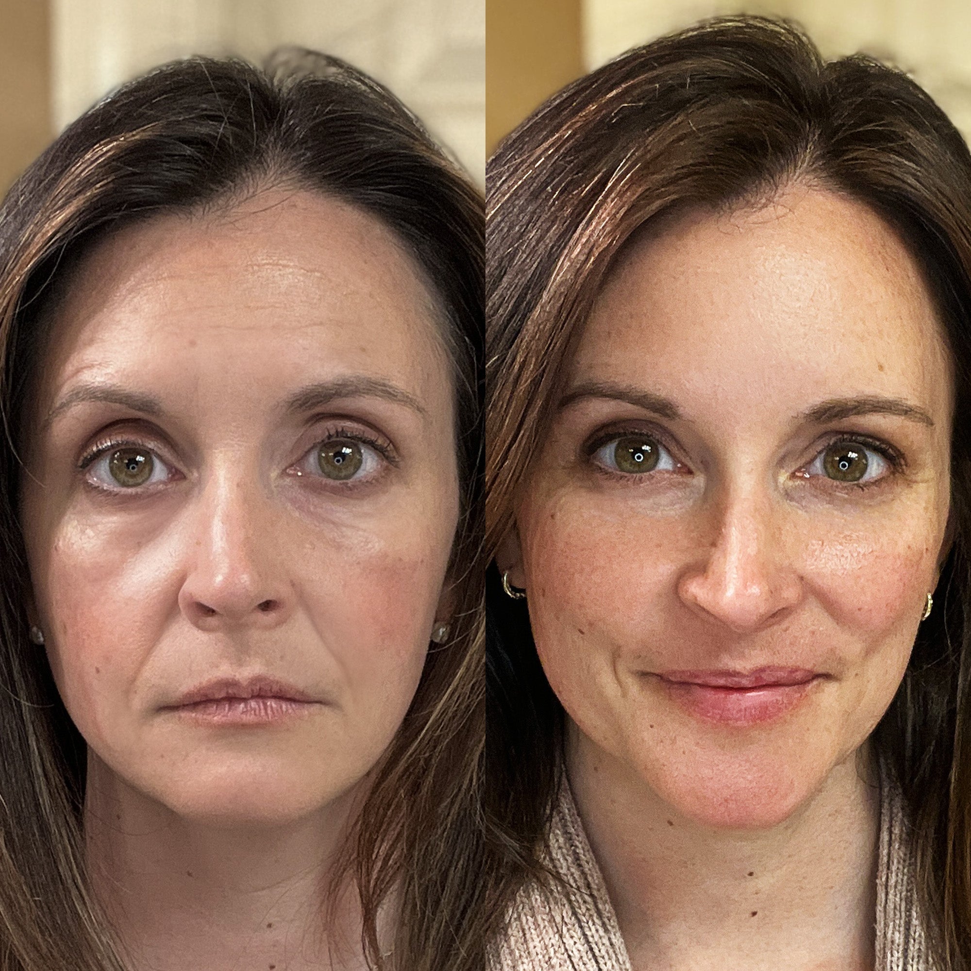 LumiLift LIGHT THERAPY®