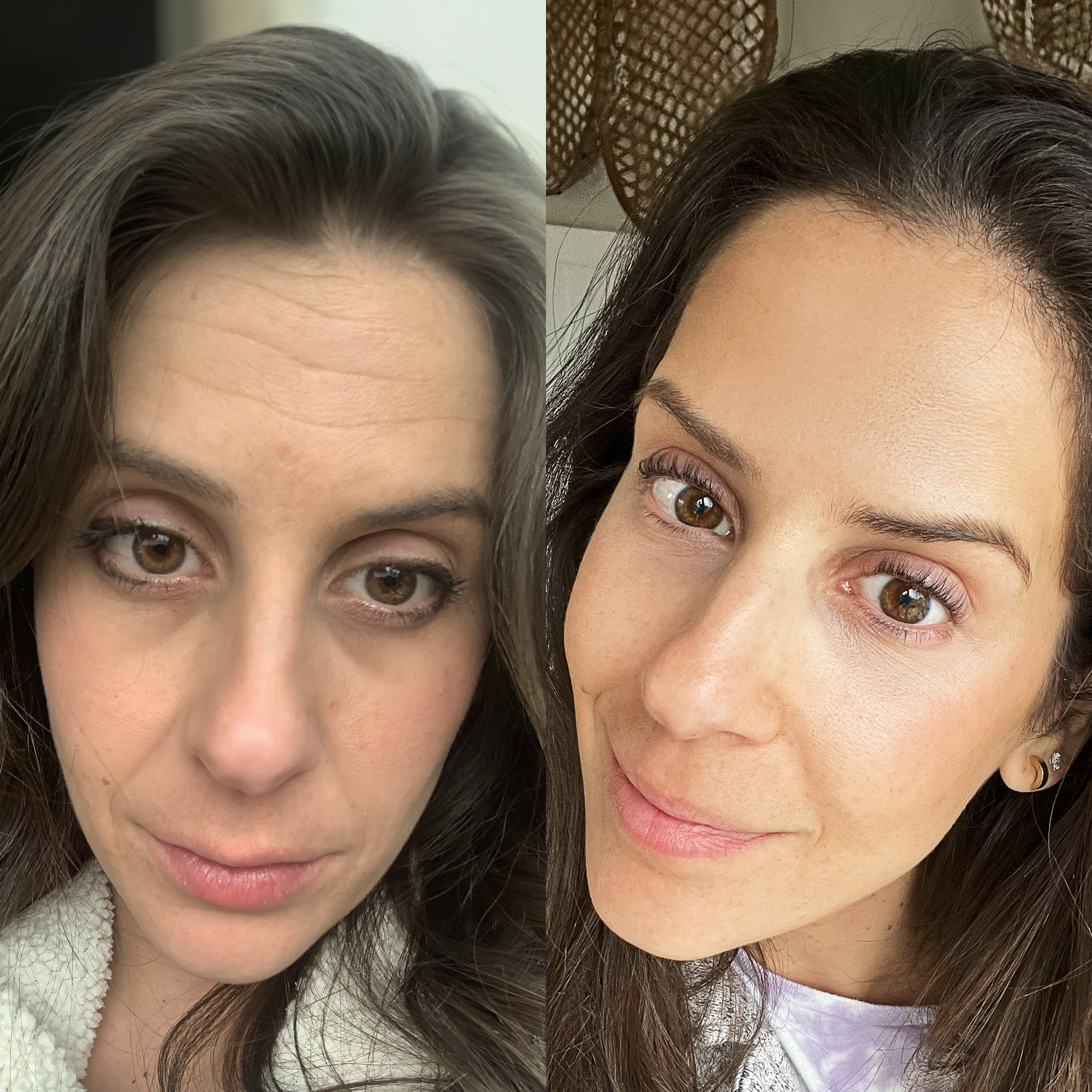 LumiLift LIGHT THERAPY®